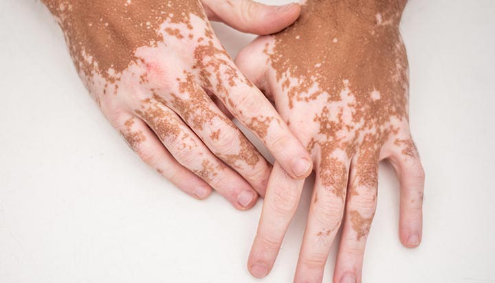 Vitiligo Treatment — Dr Nale Ayurveda
